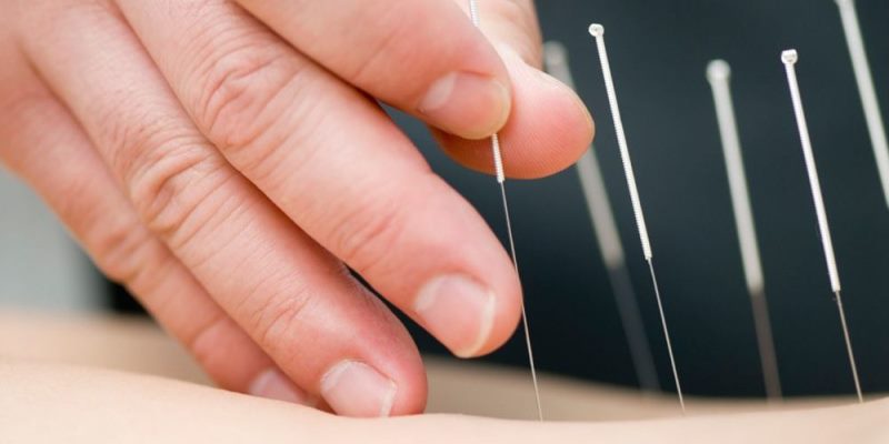 Yang Perlu Anda Ketahui Tentang Akupunktur
